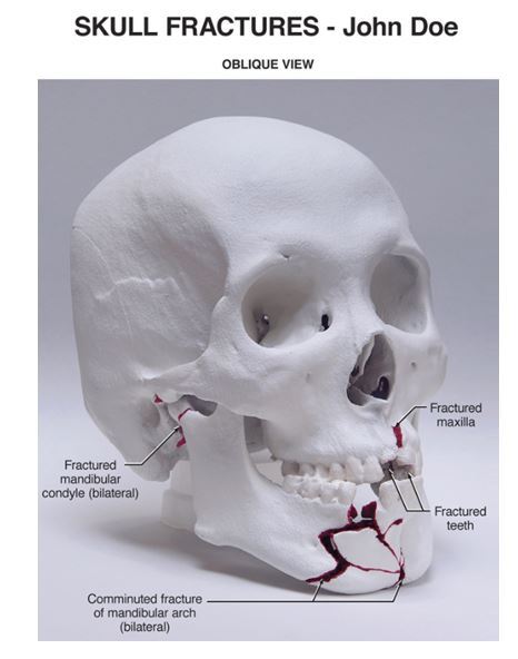 Skull Fractures